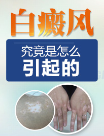 白癜风分类
