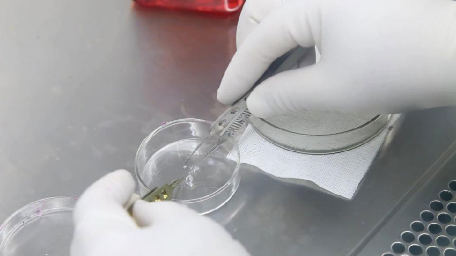 白癜风精准医学分型论治,毛囊外根鞘移植更适合稳定期白斑