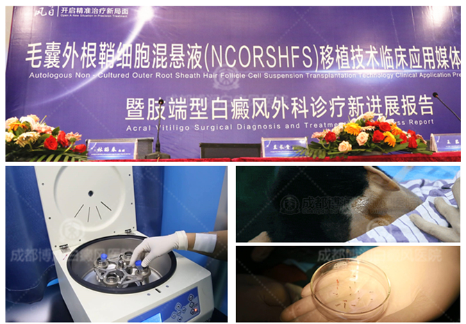 成都博润白癜风治疗新技术:毛囊外根鞘细胞混悬液移植术