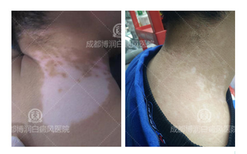 白癜风精准医学分型论治,毛囊外根鞘移植更适合稳定期白斑